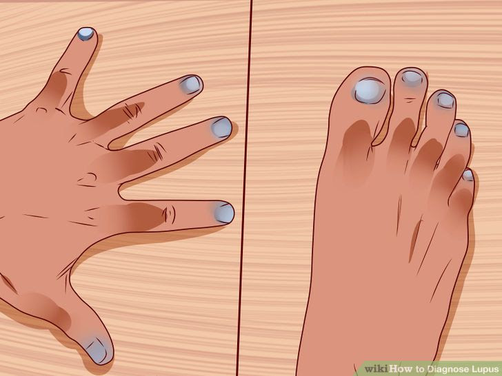 Diagnose Lupus Step 7 Version 2.jpg