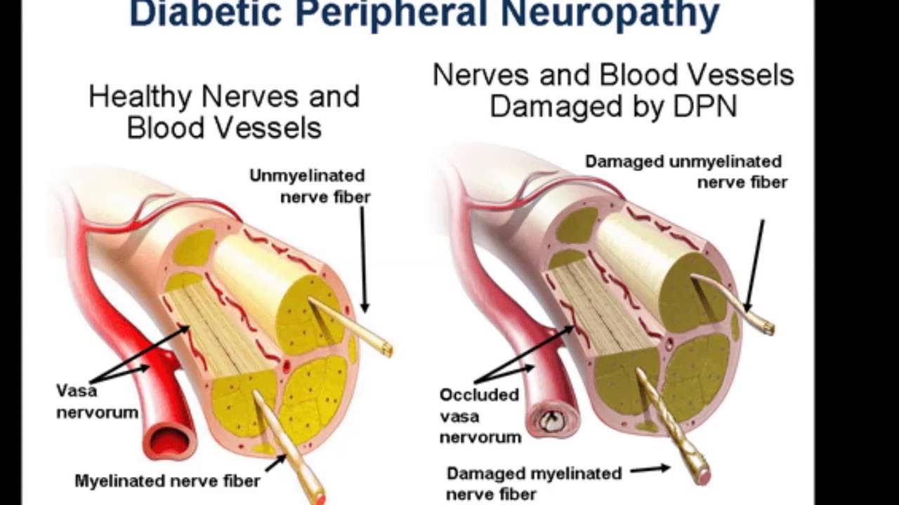 Peripheral Neuropathy Symptoms in Hands Fingers Health