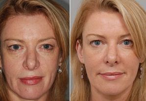  for Wrinkles on Face, Under Eyes, Help Wrinkles Vitamin E Oil Reviews