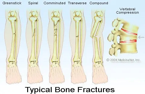 Typical Bone Fractures illustration - Compound fracture