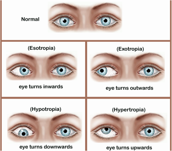 Strabismus Imu Computer Group 6 Treat The Disease Not The Symptom