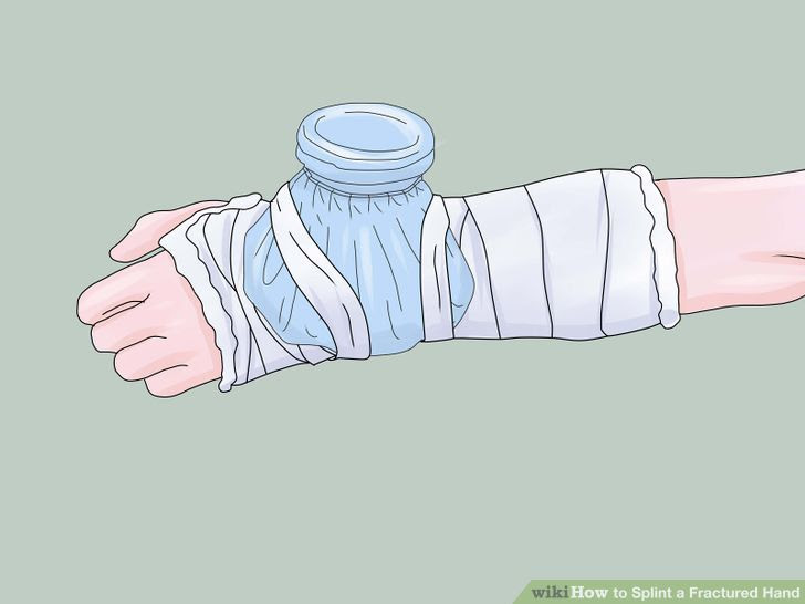 Splint a Fractured Hand Step 4.jpg