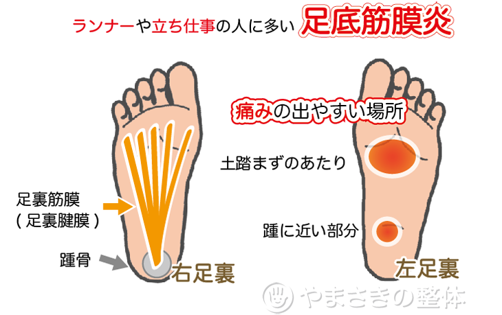 足底筋膜炎の改善 京都市中京区 やまさきの整体 慢性症状改善専門