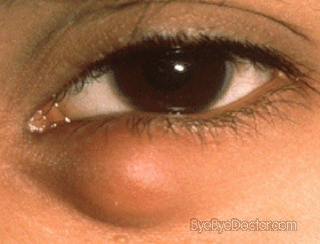Chalazion