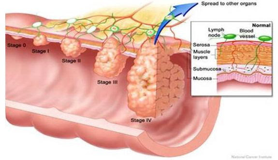 most cancers signs and symptoms near loss of life