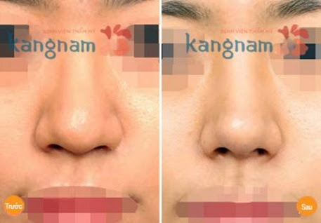 thu nhỏ đầu mũi ở đâu đẹp1