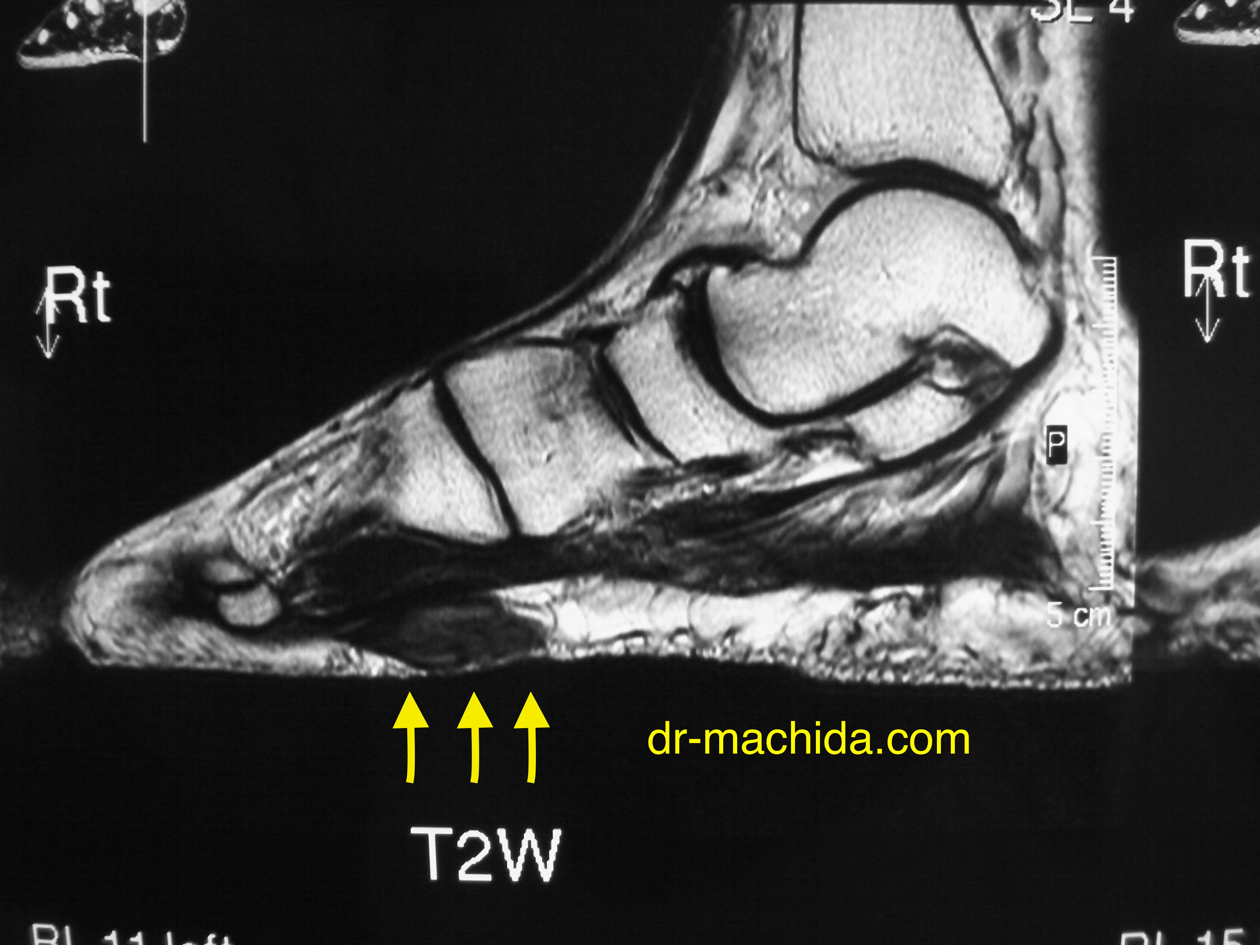 Dr Machida Com 足底線維腫 Ledderhose病