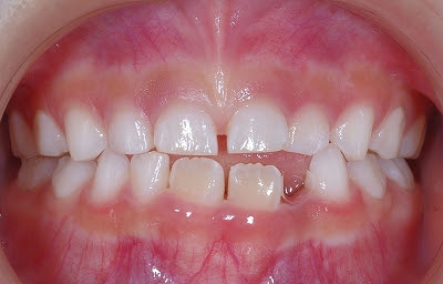 小児歯科 あき歯科医院の医院ブログ