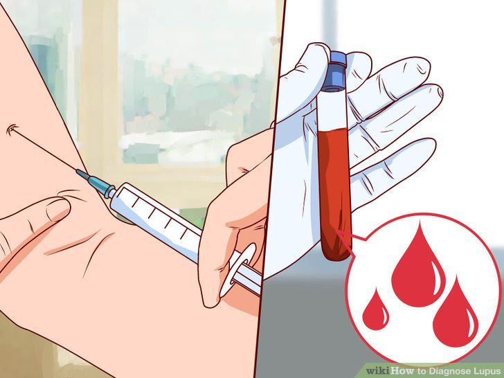 Diagnose Lupus Step 10 Version 2.jpg