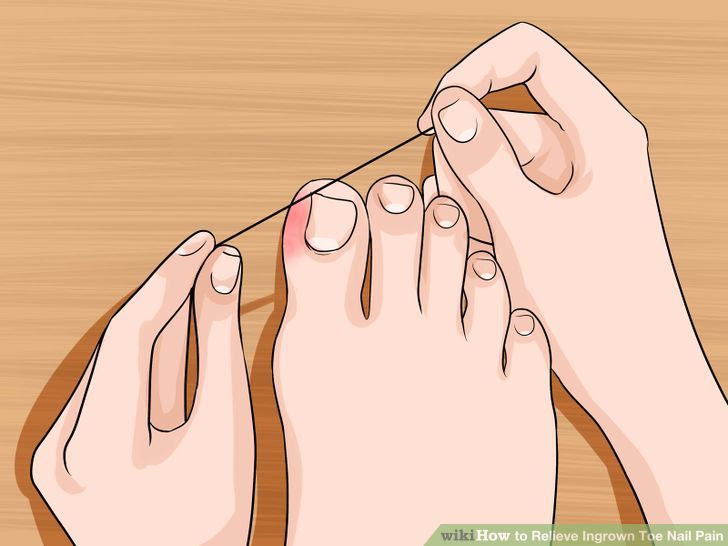 Relieve Ingrown Toe Nail Pain Step 8 Version 3.jpg