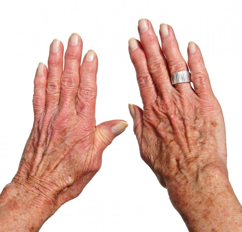 What Causes Arthritis? with pictures