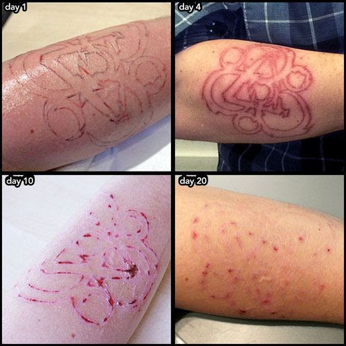 Wrecking Balm Tattoo Removal Before And After Tattoo Removal Diy
