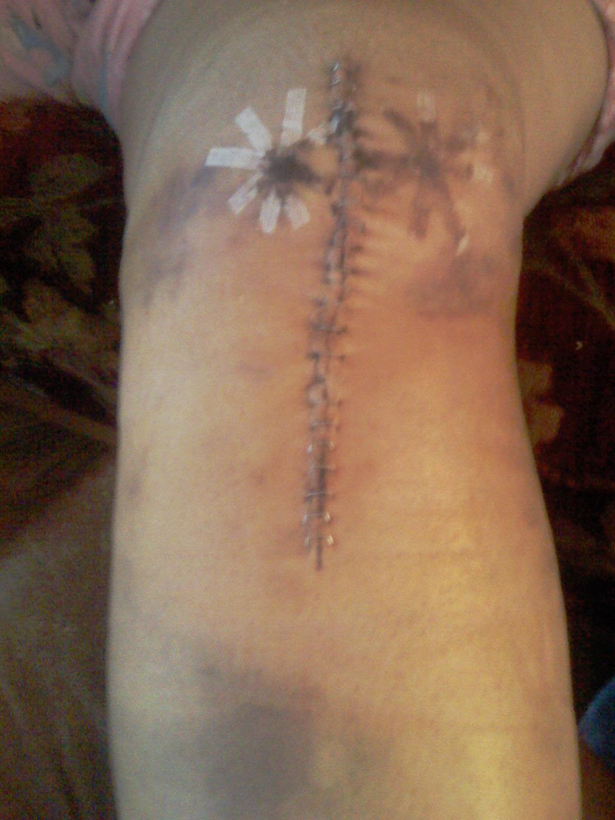cellulitis infection knee replacement | cellulitis ...