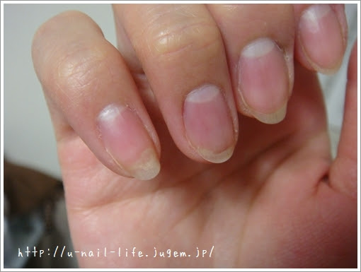 爪甲剥離完治っ U Nail Life