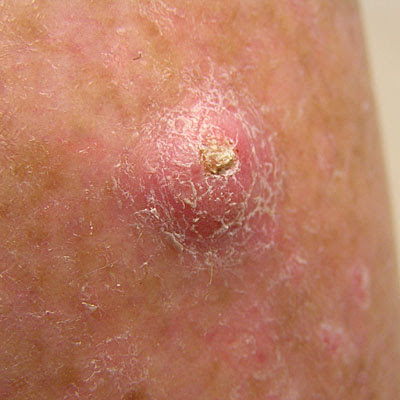 Squamous Cell Cancer: Image 1