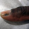 Skin Cancer Nails Pictures : Melanoma Of Nail Unit Images Dermnet Nz / Skin cancer is by far the most common type of cancer.