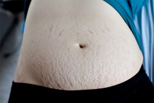 Những người béo phì thường bị rạn da.
