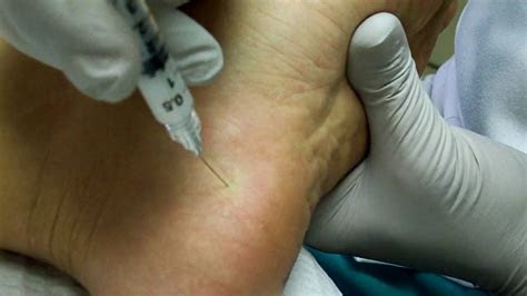The problem occurs when the plantar fascia, a band of tissues on the bottom of the foot that extends from your heel to your toes, becomes inflamed. Heel spur or plantar fascia injection - YouTube