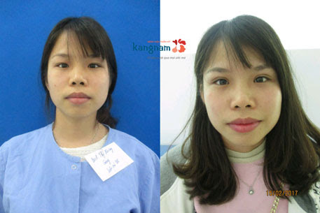 Kỹ thuật nhấn mí mắt Dove Eyes 700