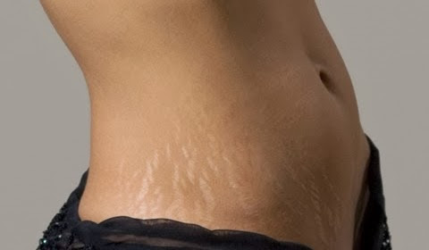 rimedi contro cicatrici