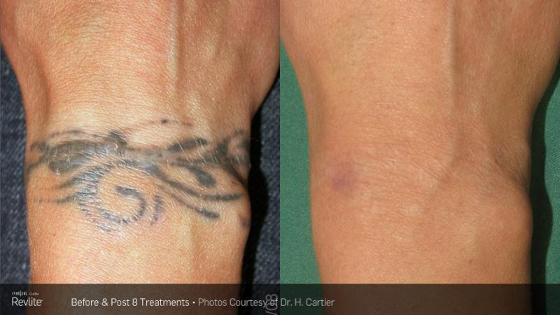 Laserase Tattoo Removal, North Vancouver BC  Ourbis