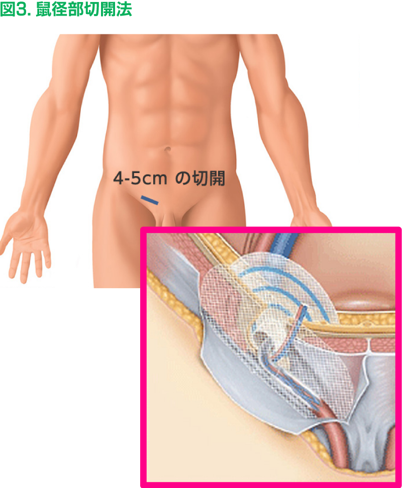 鼠径部 そけいぶ ヘルニア 脱腸 ひもんやだより Web版