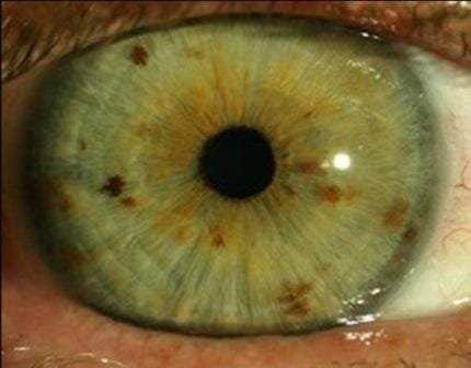 What the mean iridology green eyes? | iriscope | iridology camera