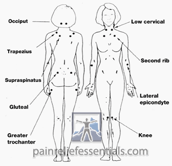 Tender points for Fibromyalgia symptoms