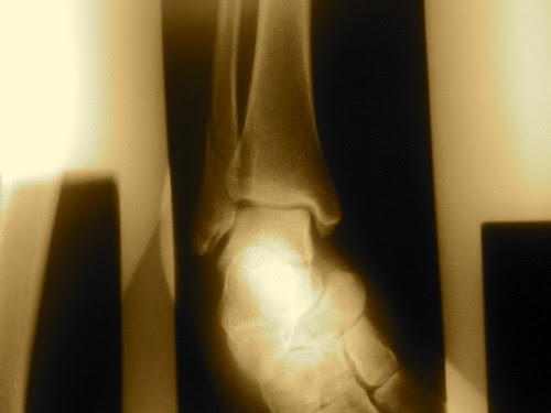 xray broken fibula