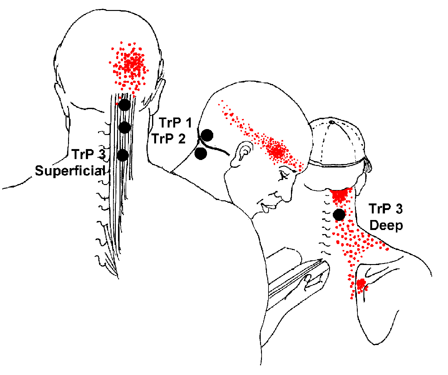 semispinalis-capitis-pain