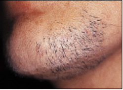 Dealing With Unwanted Facial Hair When You Have Polycystic Ovary