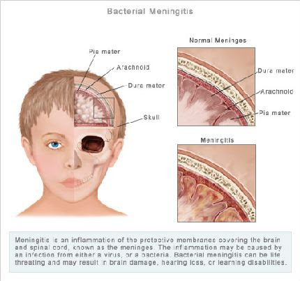 streptococcal pneumoniae