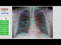 Anatomy Of Chest - Anatomy Of The Chest Cavity Medical Art Works / The chest wall is formed from the sternum anteriorly, 12 pairs of ribs, costal cartilages and intercostal muscles laterally, and the thoracic vertebrae posteriorly.