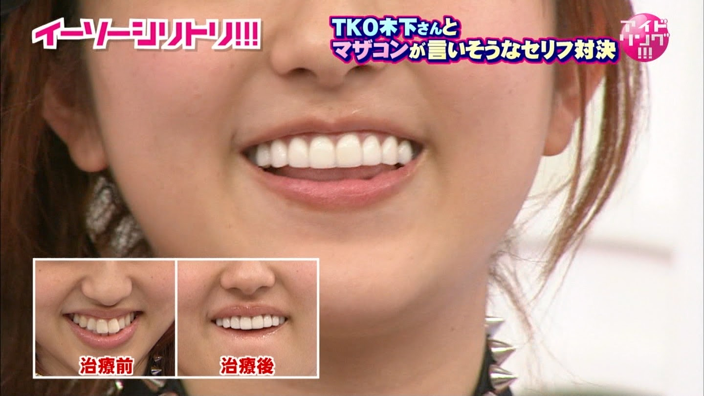 画像 芸能人は歯が命っ 菊地亜美が出っ歯を治した結果wwwwwwww ごんた兄貴のブログ