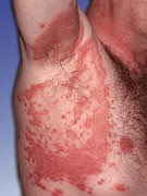 Invers psoriasis