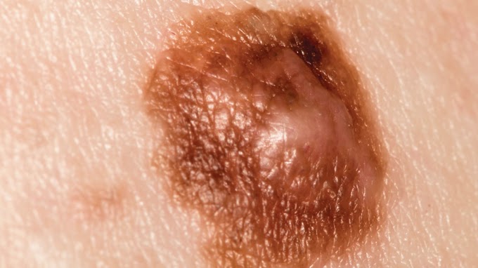 Skin Cancer Blister Melanoma - Dermofit - The deadliest form of skin cancer — melanoma — can …