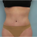 tummy tuck los angeles