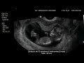 [Je voulais le plus] bébé a 5 semaine de grossesse 162471-Que fait bebe a 5 semaines de grossesse
