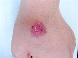 皮膚の悪性腫瘍 皮膚がん 品川区 あおよこ皮膚科クリニック
