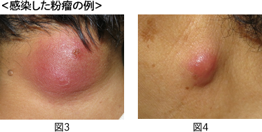 皮膚のできもの 皮膚腫瘍 Part1 粉瘤 原口クリニック 形成外科 美容外科 美容皮膚科 院長コラム