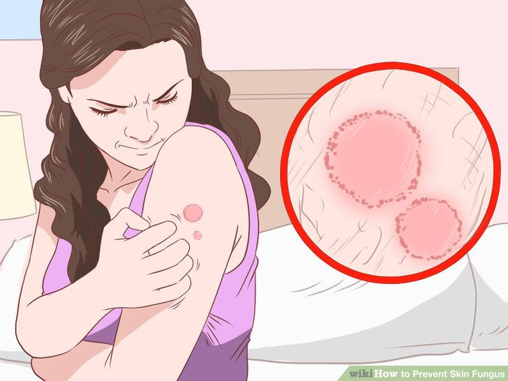 Prevent Skin Fungus Step 10.jpg