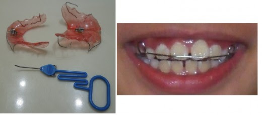 How long to wear retainers after braces? by ODS Aligners