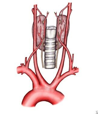 Distribution of thyroid arteries with associated l