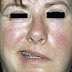 Bell's Palsy / Bells Palsy - Head - Conditions - Musculoskeletal - What ... - The weakness makes half of your face appear to droop.