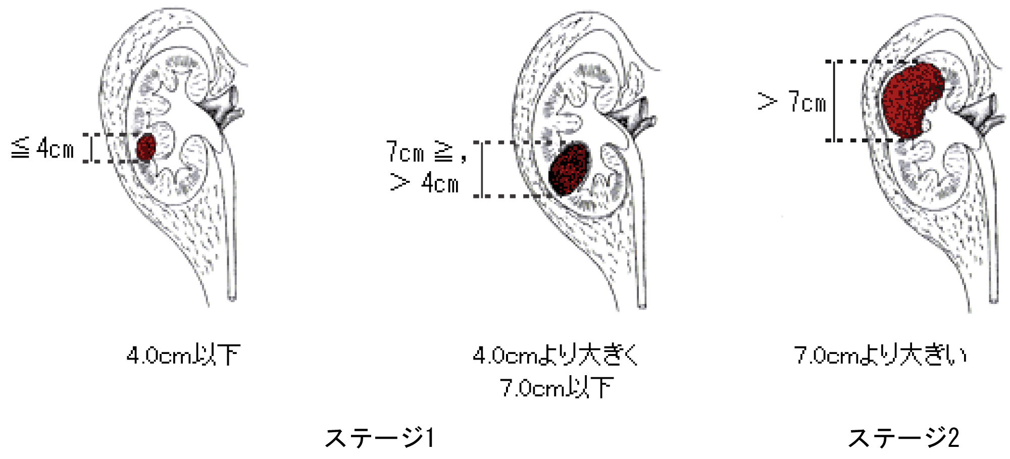 前立腺 除去 影响