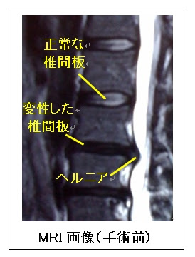 第12回 椎間板ヘルニア 傷が小さい顕微鏡手術 脊椎手術 Com