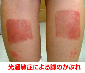 夏の湿布に気をつけよう 湿布剤による光線過敏症 10年8月 ひもんやwebだより