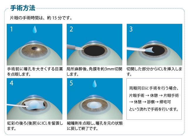 東加古川 おおみち眼科 近視矯正手術 Icl