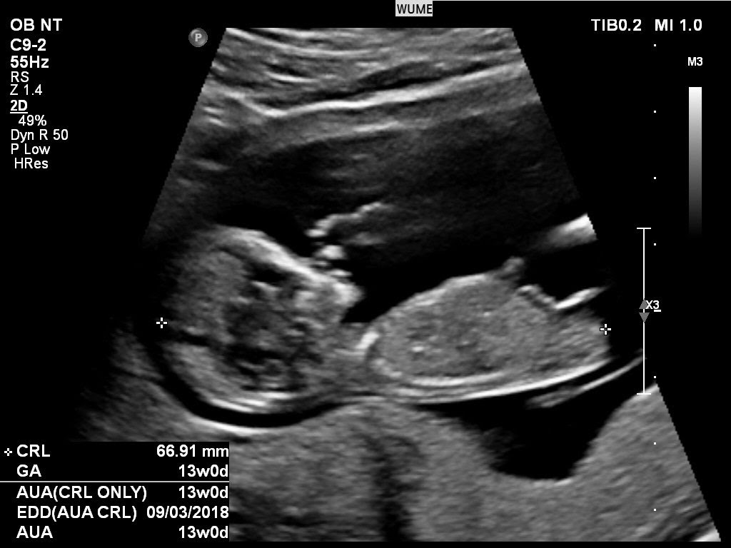 Ultrasound In Pregnancy Women S Ultrasound Melbourne