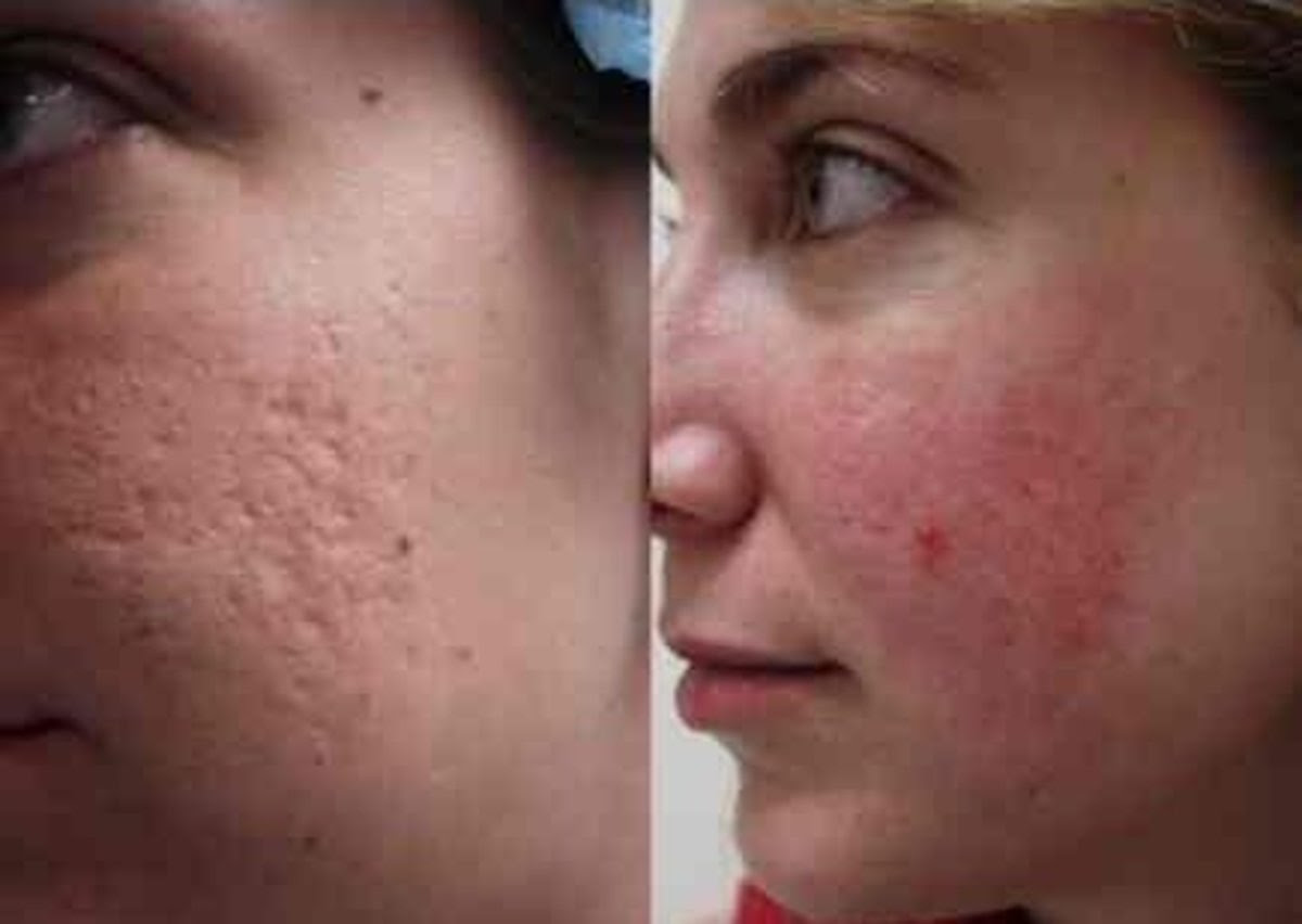 Deep acne scar treatment